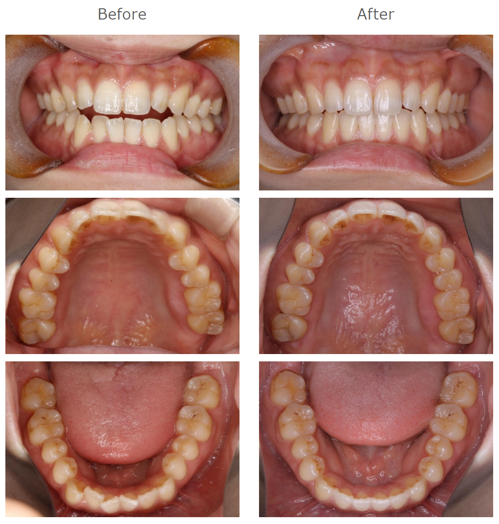 インビザライン矯正治療症例